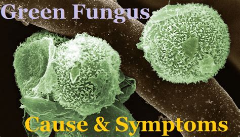 Contracting Fungal Disease from Covid